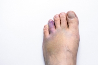 Identifying Symptoms and Individuals Prone to Broken Toes