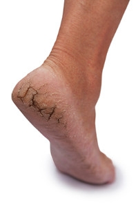 Causes of Cracked Heels