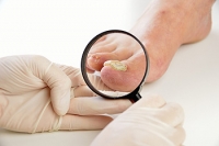 Signs of a Fungal Nail Infection