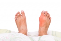 Why Do Bunions Develop?