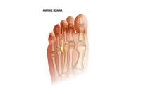 Indications of Morton’s Neuroma