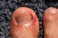 Ingrown Toenails Can Cause Pain and Discomfort